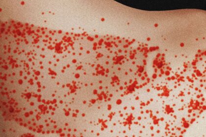 Scientists Find Measles Likely To Become Endemic in the US Over Next 20 Years